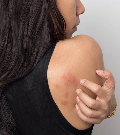 Granuloma Annulare, Types Of Rashes, Rash Causes, Heat Rash, Skin Bumps, Skin Disorders, Skin Allergies, Skin Diseases, Skin Issues