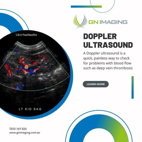 Doppler Ultrasound A Doppler ultrasound is a quick, painless way to check for problems with blood flow such as deep vein thrombosis. Learn More: https://gnimaging.com.au/ #DopplerUltrasound #ultrasound #pregnancy #d #dultrasound #pregnant #radiology #baby #genderreveal #medical #xray #healthcare #mri #dscan #imaging #medicine #radiologist #medicalimaging #health #ctscan #sonography #ultrasonography #doctor #ultrasonido #insta #momtobe #sonographer #radiologia #weekspregnant Doppler Ultrasound, Vein Thrombosis, Ct Scan, Medical Imaging, Pregnancy Week By Week, Radiology, Ultrasound, Blood Flow, X Ray