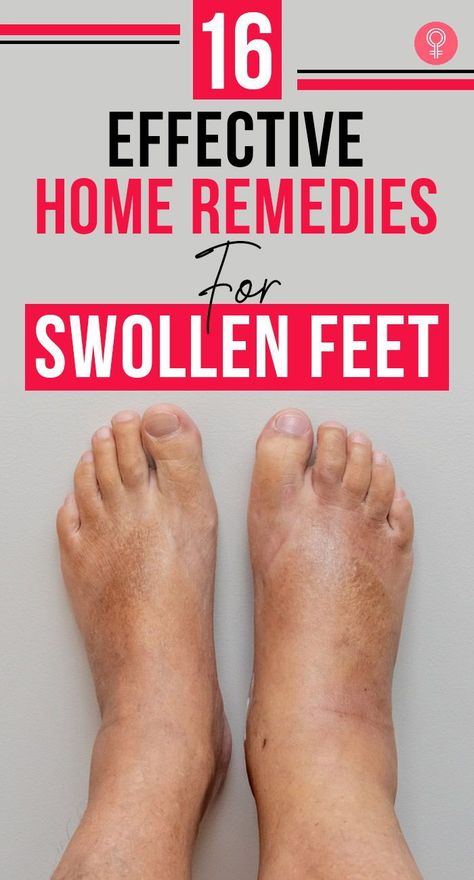 16 Effective Home Remedies For Swollen Feet: It’s time you stop suffering silently and stop treating this as a ‘not serious’ medical condition. A few hours of rest don’t always work in reducing the swelling. Here’s where our article will help you out. #remedies #homeremedies #swollenfeet #health #healthcare #healthcaretips #wellness Reduce Swelling In Feet Remedies, Swollen Feet Remedies How To Get Rid, Foot Swelling Remedy, Swollen Ankles Remedies, Feet Swelling Remedies, Reduce Swelling In Legs And Ankles, Leg Swelling Remedies, Ankle Swelling Remedies, Swollen Ankle Remedies