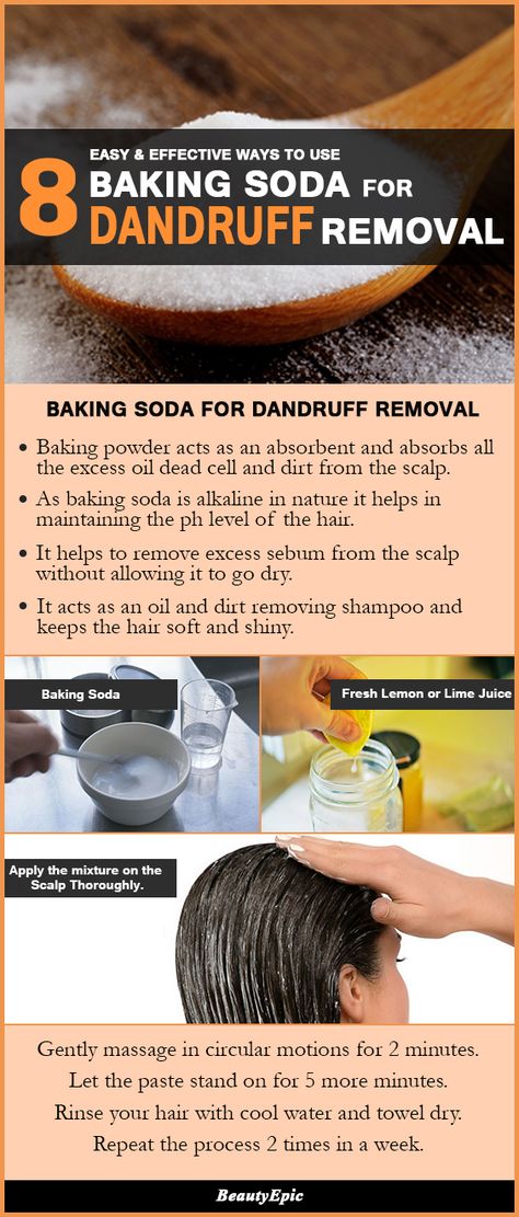 8 Easy and Effective Ways to Use Baking Soda For Dandruff Removal Baking Soda For Scalp, Baking Soda Scalp Scrub, Dandruff Remedy Severe At Home, How To Get Ride Of Dandruff Fast At Home, How To Remove Dandruff From Scalp, How To Remove Dandruff, Baking Soda For Skin, Baking Soda For Dandruff, Dandruff Removal