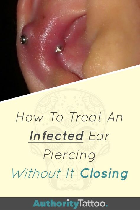 Nobody wants a piercing to close due to infection. Treating infections efficiently will spare you further complications. Click the pin to learn how to save your piercing. Ear Piercing Infection Remedy For Kids, Cartilage Piercing Infection, Infected Ear Piercing, Ear Piercing Care, Piercing Bump, New Ear Piercing, Piercing Care, Ear Peircings, Double Ear Piercings