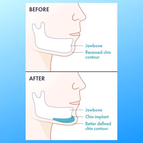 Chin Implant Before And After Women, Chin Implant Woman, Chin Implant Before And After, Weak Chin, Chin Surgery, Facial Aesthetic, Chin Augmentation, Chin Implant, Facial Procedure