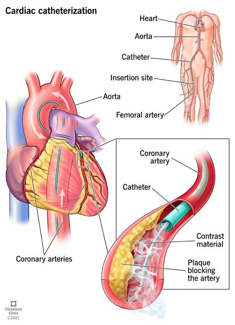 Heart Catheterization, Heart Pressure, Catheter Insertion, Cardiac Sonography, Heart Arteries, Vascular Ultrasound, Chest Discomfort, Nursing School Essential, Medical Pictures