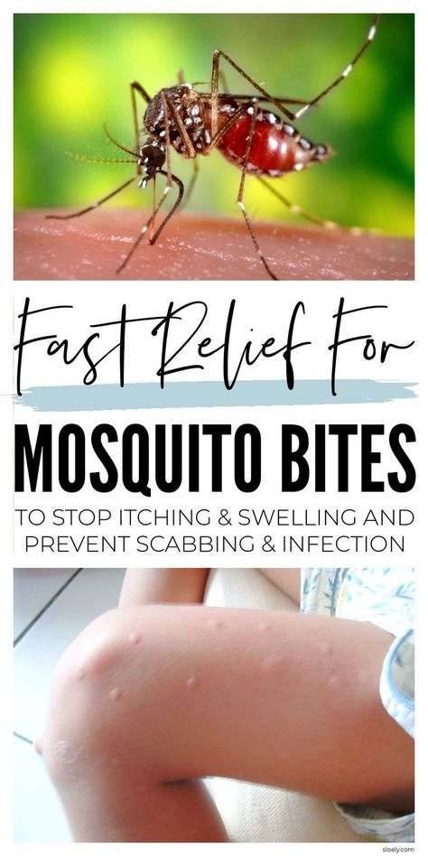 Mosquito Bite Relief Mosquito Bites Remedy, Misquote Itch Relief Diy, How To Soothe Mosquito Bites, Diy Itch Relief Insect Bites, Home Remedy For Mosquito Bites, How To Stop Itching From Mosquitos, Natural Remedy For Mosquito Bites, Essential Oil For Mosquito Bites Itch Relief, Natural Mosquito Bite Relief