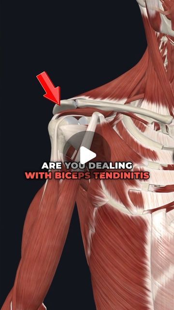 Dr. Adam McCluskey PT, DPT on Instagram: "💥Pain in the Front of Your Shoulder?💥 (Full Shoulder Program on SALE today in Bio link!...) . 🔑Anterior (front) Shoulder pain can come from a few different things, but one common source is irritation of the long head of the biceps tendon. That’s what I want to focus on today. —- ➡️Biceps tendinopathy will present as pain along the front of the shoulder made worse by things like lifting the arm out in front of you, loaded pressing motions, and end range shoulder extension (like dips). ——- 😫This typically involves irritation of the long head biceps tendon as it crosses through a grove over the front of the shoulder. —— ✅To start with, it’s important to calm things down by avoiding aggravating movements, build up posterior shoulder strength, good Tendonosis Shoulder, Bicep Tendon Repair Exercises, Biceps Tendinopathy, Shoulder Bursitis, Anatomy App, Bursitis Shoulder, Focus On Today, Shoulder Movement, Sore Shoulder