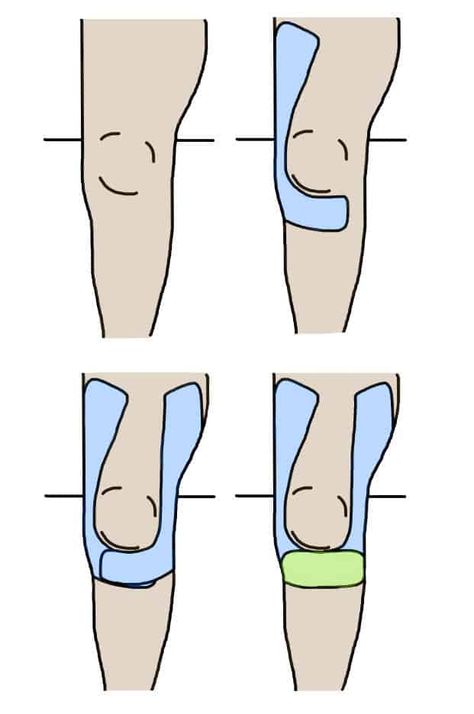 How to Apply Tape for Knee Pain: 4 Techniques - Injury Health Blog Knee Stability Taping, Kt Tape For Knee Support, How To Use Kt Tape On Knee, Sports Tape Knee, How Do You Kt Tape Your Knee, Knee Support Taping, How To Put Kt Tape On Your Knee, Knee Tape Support, How To Tape Knee For Support