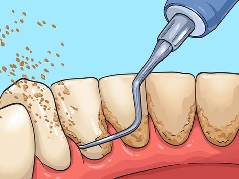 How To Remove Hardened Plaque, How To Get Rid Of Plaque Build Up, How To Clean Plaque From Teeth, Diy Plaque Remover Teeth, How To Remove Plaque From Teeth, How To Get Plaque Off Teeth, Clean Teeth Plaque How To Remove, Teeth Plaque Removal At Home, Removing Plaque From Teeth At Home