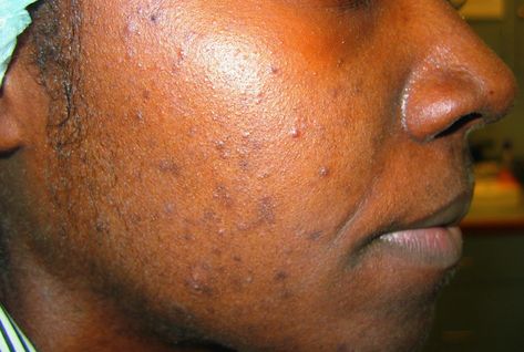 Acne Vulgaris - Dermatologic Disorders - MSD Manual Professional Edition Pustules Acne, Treating Cystic Acne, Cleansing Bath, Moderate Acne, Acne Vulgaris, Severe Acne, Light Candles, Cystic Acne, First Crush