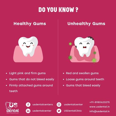 "Do you know? What are the symptoms of Healthy Gums and Unhealthy Gums? Dentist Social Media Content, Dental Content Ideas, Dental Advertising Ideas Social Media, Dental Content, Dental Post, Dentist Ideas, Dental Ads, Toothache Remedies, Dentist Social Media