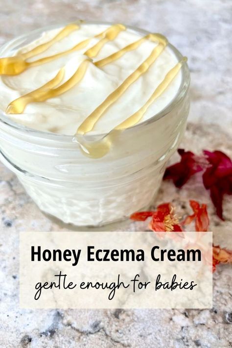 Homemade Excema Cream, Homemade Excema Remedy, Body Butter For Excema, Lotion For Excema, Diy Excema Cream Recipes, How To Heal Excema, Excema Remedies For Face, Baby Excema Remedies Diy, Exema Treatments Natural