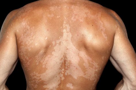 Causes of Skin Discoloration | WebMD Closed Comedones, Dry Scaly Skin, Skin Blackheads, Hydrocortisone Cream, Scaly Skin, Types Of Acne, Lighter Skin, Skin Disorders, Skin Diseases