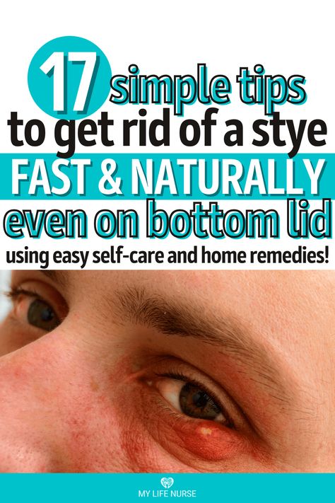 person's eye with stye on bottom lid Sty Remedy How To Get Rid, Sty In The Eye Remedies How To Get Rid, Get Rid Of A Stye Overnight, Stye Remedies Fast Essential Oils, Remedies For Stye On Eyelid, Stye Remedies Fast How To Get Rid At Home, Natural Remedies For Stye Eye, How To Get Rid Of Stye Eye, Sty Eye Remedies How To Get Rid