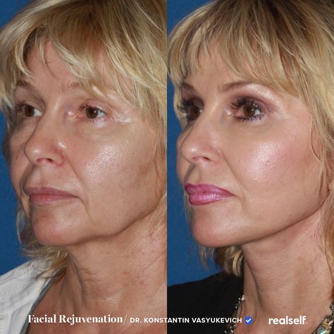 More Defined Jawline, Sagging Neck Skin, Chin Wrinkles, Neck Lift Surgery, Home Facial Treatments, Defined Jawline, Sagging Neck, Laser Facial, Face Lift Surgery