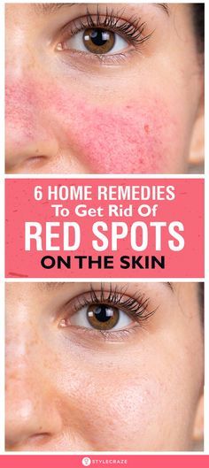 Diy Face Redness Remedy, Skin Spots On Face, Get Rid Of Facial Redness, Remedies For Redness On Face, What Helps With Redness On Face, How To Get Rid Of Red Face, Redness Reducing Skin Care Natural, Red Veins On Face How To Get Rid, How To Stop Redness On Face Skin Care