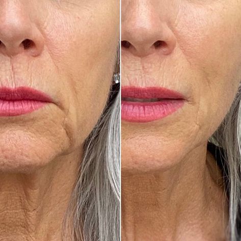 Wrinkles Before And After, Microcurrent Before And After, Nuface Before And After, Nuface Mini, Skincare Serums, Skincare Sets, Seeing Is Believing, Natural Anti Aging Skin Care, Facial Devices