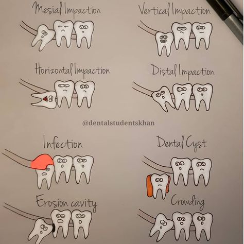 Infection(pericoronitis): An impacted wisdom tooth will start to push through the gum and an infection can start around the top of the tooth. Infection and inflammation can cause pain, swelling and jaw stiffness.   Crowding: A wisdom tooth may push nearby teeth out of their correct position and may help to cause crowding of front teeth Dental Hygiene, Dental Implants, Dental Care, Teeth Whitening, Healthy Living