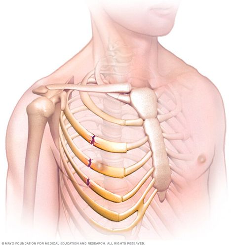 broken ribs Dr Ideas, Broken Ribs, Rib Bones, Bone Fracture, Health Guide, Chest Pain, Mayo Clinic, Biochemistry, Healing Process