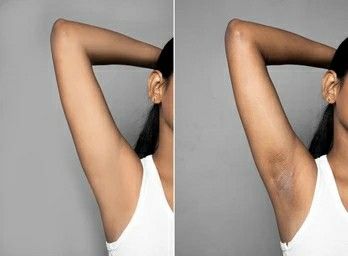 Practical steps that helps in clearing dark armhole Get Rid Of Dark Armpits, Tumeric And Honey, Bamboo Charcoal Soap, Dark Armpits, Cream For Dark Spots, Dark Underarms, Charcoal Soap, Fade Dark Spots, Remove Dark Spots