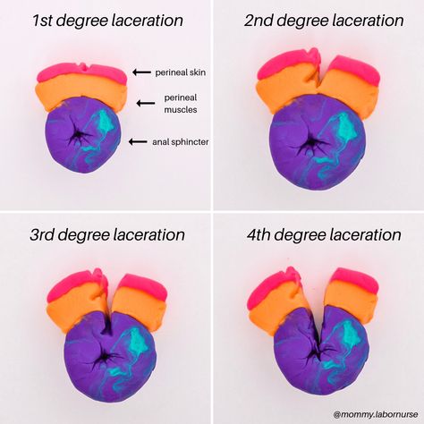 Episiotomy Vs. Tearing: Do You Know Which One is Better? Labor And Delivery Nurse Education, Labor And Delivery Nursing, Obgyn Nurse, Nursing Instructor, Newborn Nursing, Midwifery Student, Postpartum Nursing, Ob Nurse, Student Midwife