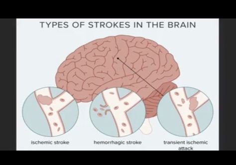 Different Types Of Strokes, Types Of Strokes, Loss Of Balance, Brain Damage, Warning Signs, The Brain, Disease, Healthy Living, Brain