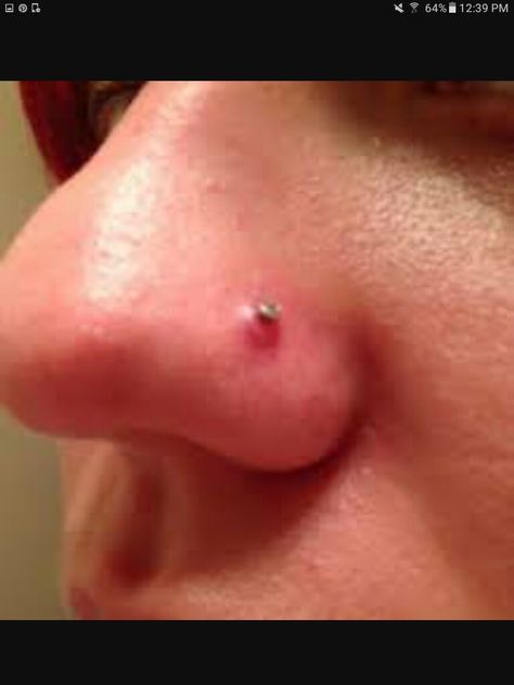 keloid Nose Ring Bump, Nose Piercing Big Nose, Infected Nose Piercing, Nose Piercing Bump, Piercing Bump, Itchy Nose, Doterra Lavender, Pierced Nose, L Shaped Nose Ring