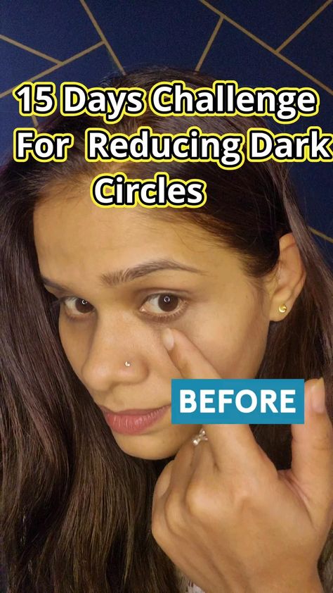 💪🏻15 Day Challenge for Under Eye Dark Circle Reduction Potato and Honey #shorts #darkcircles Eye Bag Remedies, Dark Undereyes, Dark Circle Remedies, Dark Circles Around Eyes, Honey Beauty, Dry Skincare, 15 Day Challenge, Good Skin Tips, Facial Sheet Mask