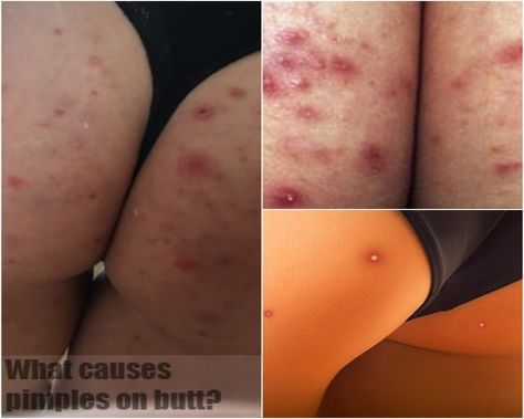 pimples on butt Body Pimples Remedies, How To Have Smooth Buttocks, How To Get Rid Of Inner Thigh Pimples, How To Get Rid Of Dark Spots On Buttocks, How To Get Rid Of Pimples On Buttocks, How To Shave Buttocks, How To Get Rid Of Bumps On Buttocks, Clear Buttocks Skin Care, How To Get Rid Of Buttocks Acne At Home