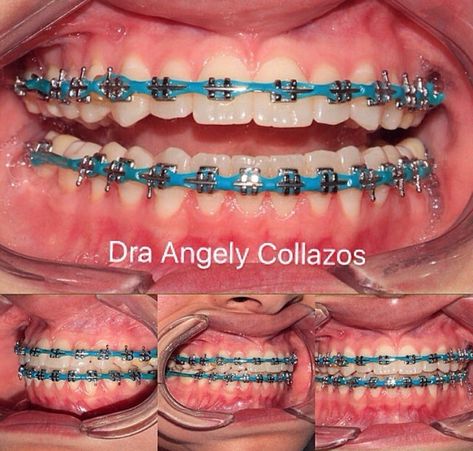 Braces Color Power Chain, Blue Power Chain Braces, Teal Power Chain Braces, Power Chain Braces Colors, Powerchain Braces Color, Power Chain Braces, Dental Braces Colors, Braces Colors Combinations, Jewelry Teeth