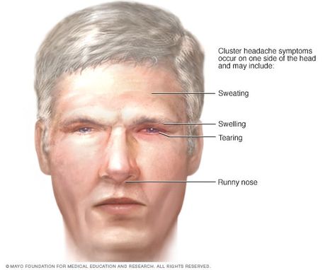 Cluster headache - Symptoms and causes - Mayo Clinic Cluster Headache, Headache Causes, Migraine Pain, Severe Headache, Prevent Constipation, Brain Cells, Mayo Clinic, Signs And Symptoms, Lifestyle Changes