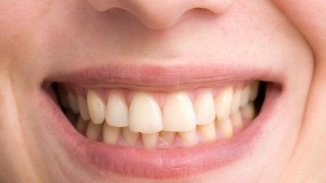 Coconut Oil Teeth Whitening, Cosmetic Dentistry Veneers, Teeth Whitening Homemade, Discolored Teeth, Teeth Whitening Remedies, Teeth Whitening Toothpaste, Laser Teeth Whitening, Charcoal Teeth Whitening, Pasta Dental