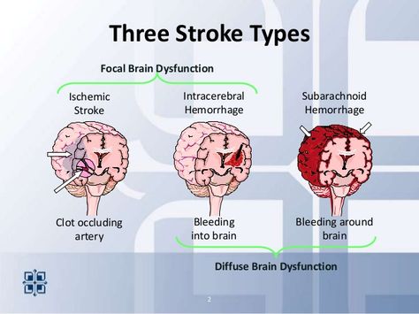 types of strokes | 2013.stroke areyouready Types Of Strokes Nursing, Emt Study, Types Of Strokes, Nurse Study Notes, Nursing Student Tips, Medical Student Study, Cardiac Nursing, Nursing School Survival, Nursing School Studying