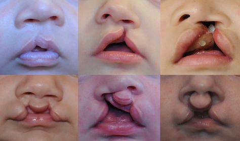 Eustachian Tube Dysfunction, Lip Surgery, Ear Tubes, Cleft Lip And Palate, Teeth Alignment, Oral Maxillofacial, Bone Grafting, Cleft Palate, Facial Surgery