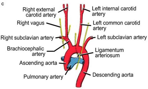 aortic arch branches Aortic Arch, Subclavian Artery, Intracranial Pressure, Carotid Artery, Health Cleanse, Metabolic Disorders, Health Pictures, Circulatory System, Health Logo