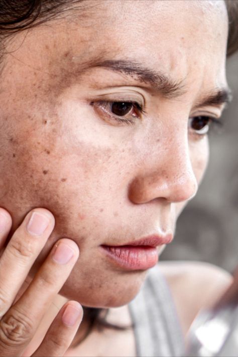 Hyperpigmentation can be extremely difficult to treat. In this post we discuss how combining Hydroquinone and Tretinoin can offer a potent solution to safely and effectively fade dark spots and even out skin tone. Pigmented Skin, Dark Spots On Face, Serious Skin Care, Dark Spots On Skin, Skin Spots, Clear Skin Tips, Spots On Face, Beauty Natural Products, Remove Dark Circles