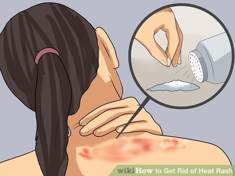 Heat Rash On Face, Treating Heat Rash, Heat Bumps, Heat Rash Remedy, Home Remedies For Rashes, Prickly Heat Rash, Allergy Rash, Body Rash, Rash On Face