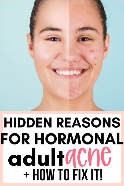 #acne #acnetreatment #naturalacnetreatment Hormonal Acne Causes, How To Treat Hormonal Acne Naturally, Acne Breakout Chart, Fastest Way To Get Rid Of Pimples, Acne Areas Meaning, Natural Remedies For Cystic Acne, Acne At Age 40, How To Help Hormonal Acne, Heal Hormonal Acne