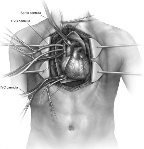 Cardiac Autotransplantation - Operative Techniques in Thoracic and Cardiovascular Surgery Cardio Thoracic Surgery Aesthetic, Surgery Illustration, Thoracic Surgery, Heart Facts, Heart Structure, Mitral Valve, Medical Wallpaper, Google Scholar, Heart Surgery