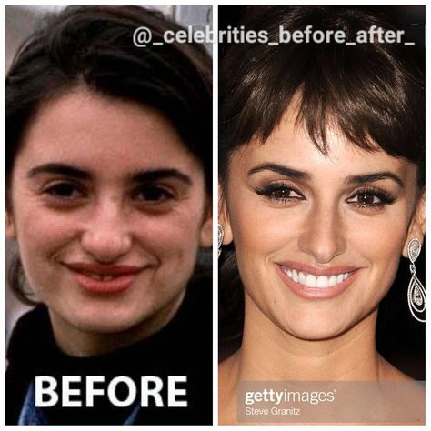 Celebrity Before And After Surgery, Celebrities Before And After Surgery, Aesthetic Procedures, Cheek Implants, Plastic Surgery Fail, Plastic Surgery Gone Wrong, Botox Lips, Face Surgery, Face Lift Surgery