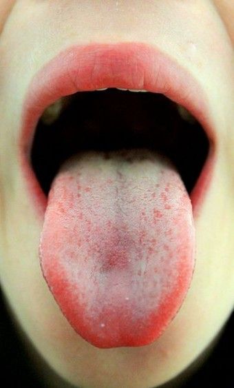 Supertaster? How to tell...more or less scientifically. Tongue Painting, Burning Tongue, Tongue Out, Remedies For Dry Mouth, White Tongue, Dry Mouth, Tongue Health, Oral Care Routine, Average Person