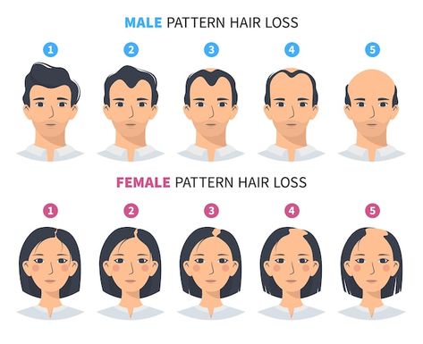 Hair loss stages androgenetic alopecia m... | Premium Vector #Freepik #vector #hair-growth #hair-loss #scalp #hair-problem Male Hairline, Androgenic Alopecia, Hair Transplant Results, Androgenetic Alopecia, Health Guru, Male Pattern Baldness, Pattern Baldness, Lost Hair, Hair Solutions