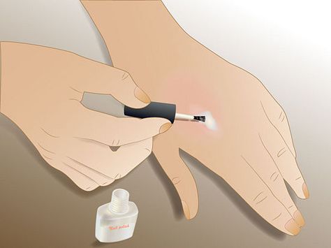 I ALWAYS USE CLEAR NAIL POLISH TO STOP BUG BITES. we never have the anti itch cream (article: 4 Ways to Get Rid of a Mosquito Bite - wikiHow) How To Stop Bug Bites From Itching, Stop Bug Bites From Itching, Mosquito Bite Remedy, Mosquito Bites Stop Itching, Treating Mosquito Bites, Remedies For Bee Stings, Remedies For Mosquito Bites, Bug Bites Remedies, Bite Relief