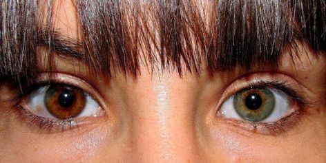 Heterochromia in the iris of one eye Change Eye Color, Heterochromia Eyes, Rare Eye Colors, Woman Eyes, Grey's Anatomy Doctors, Rare Eyes, Change Your Eye Color, Different Colored Eyes, Architecture Tattoo