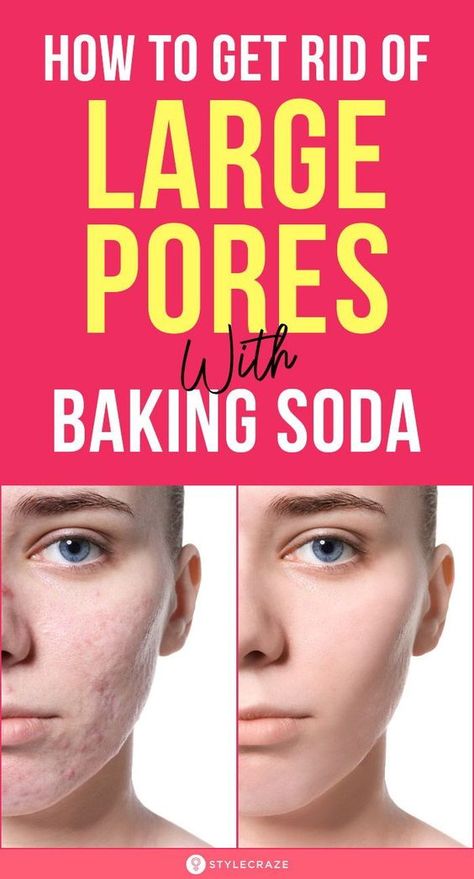 Benefits Of Baking Soda, Baking Soda Face, Baking Soda Benefits, Baking Soda Cleaning, Baking Soda Uses, Baking Soda Shampoo, Moisturizer For Oily Skin, Large Pores, Best Moisturizer