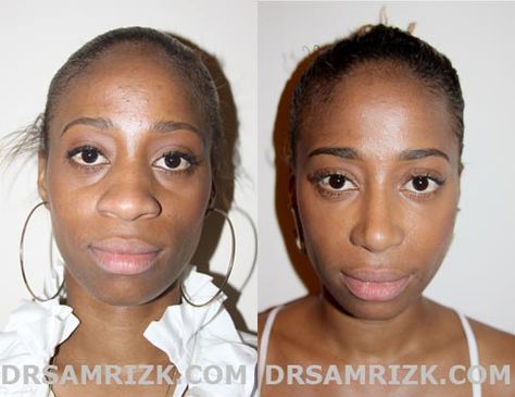 African American Rhinoplasty in NJ, PA | African American Nose Job in Boson Rhinoplasty Before After, Pimple Inside Nose, Acne On Nose, Nose Plastic Surgery, Nose Surgery Rhinoplasty, Ethnic Rhinoplasty, Bulbous Nose, Nose Jobs, Rhinoplasty Nose Jobs