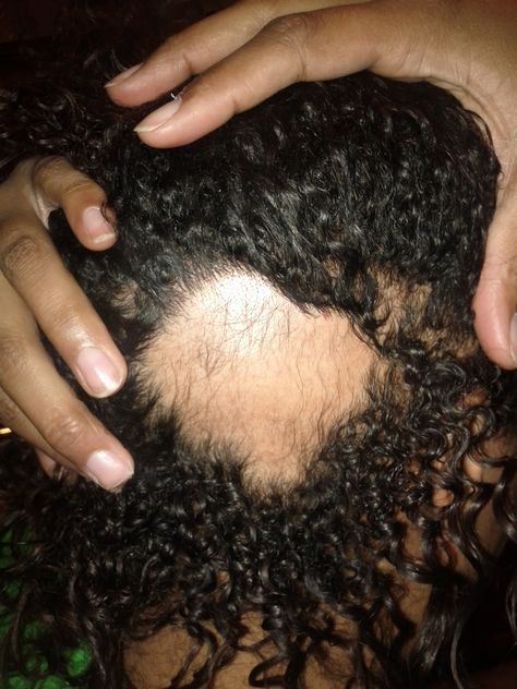 What You Should Do When You Notice A Bald Spot In Your Hair  Read the article here - http://blackhairinformation.com/growth/hair-growth/notice-bald-spot-hair/ Bald Spots Women, Grow Hair Back, Alopecia Hairstyles, Bald Patches, Black Hair Dye, Bald Spot, Bald Hair, Regrow Hair, Hair Advice