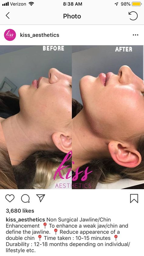 Perfect Chin Shape, Jaw And Chin Filler, Face Contouring Fillers, Facial Balancing Filler, Chin Fillers Before After, Nose Profile, Jaw Reduction Surgery, Chin Filler, Facial Procedure