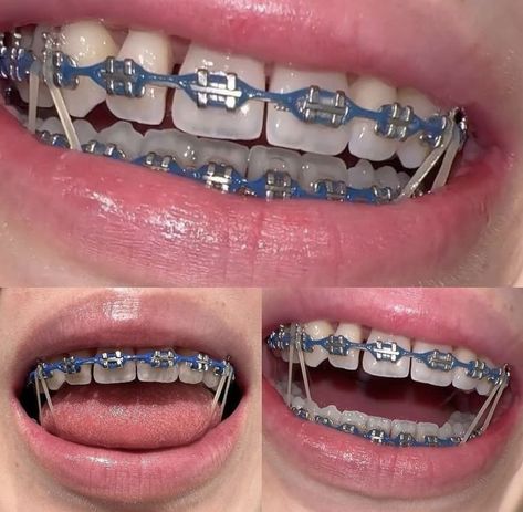 Midnight Glow Braces, Braces Chain Colors, Silver Power Chain Braces, Braces Colors For Latinas, Teeth Braces Colors, Power Chain Braces Colors, Brace Colors Ideas, Braces Aesthetic Colors, Light Purple Braces