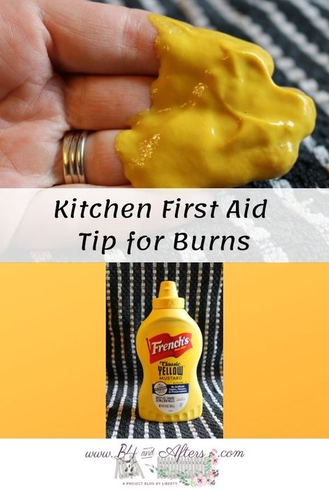 How To Help A Burn On Hand, Home Remedy For Burns Hands, Burn Remedies Hand, How To Heal Bruising Fast, Burn Relief Hand, Hand Burns Skin, Burn Remedies, Blister Remedies, Home Remedies For Burns