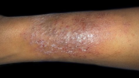 Dry skin patches: Causes, symptoms, diagnosis, and treatments Rash On Face, Scale Skin, Scaly Skin, Skin Patches, Dry Skin Patches, Red Patch, Cracked Skin, Peeling Skin, Skin Disorders