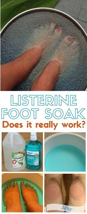 Pedicure Soak, Listerine Foot Soak, Foot Soak Recipe, Diy Pedicure, Pedicure At Home, Foot Soak, Toenail Fungus, Lower Belly, Healthy Detox